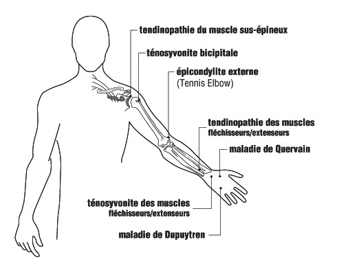 Carte du bras